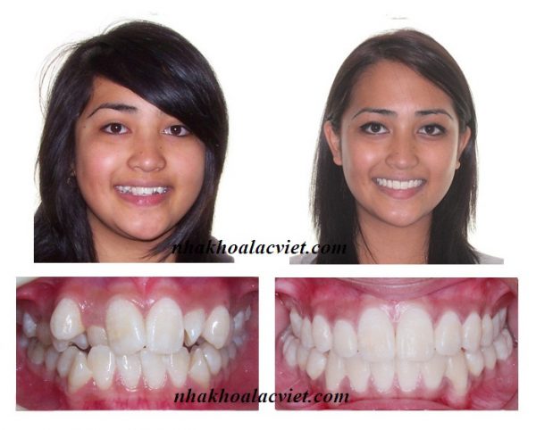 hình ảnh trước và sau khi niềng răng