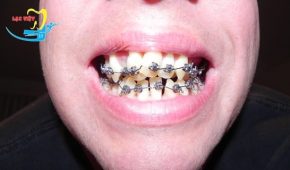 Có nên niềng răng khấp khểnh không?