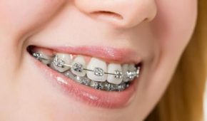 Răng hô là gì, nguyên nhân nào dẫn đến răng hô?