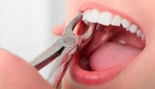 Niềng răng trong suốt có phải nhổ răng không?