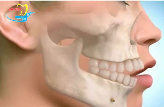 răng hô là gì và quy trình niềng răng hô