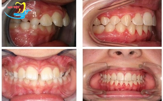 Kết quả niềng chỉnh răng hô cho người lớn