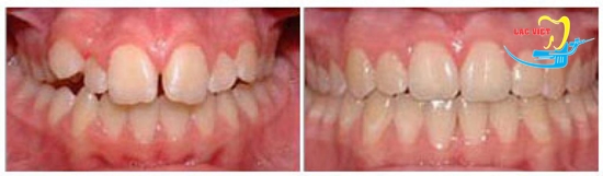 Kết quả một trường hợp niềng răng hô đúng quy trình niềng răng hô quốc tế