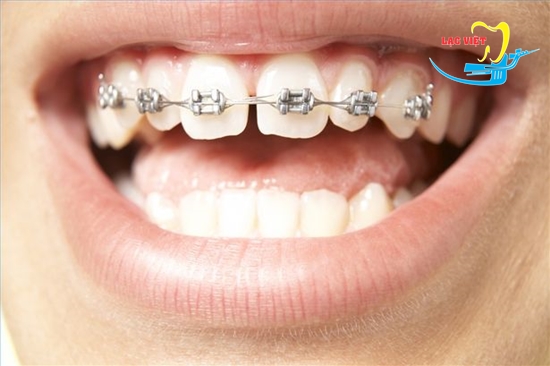 Niềng răng là phương pháp khắc phục răng thưa vĩnh viễn