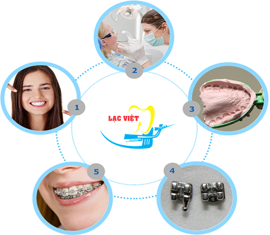 Quy trình niềng chỉnh răng hô tại nha khoa Lạc Việt