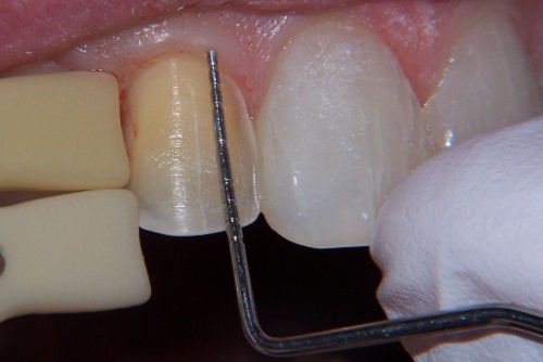 Có nên bọc răng sứ cho răng hô vẩu không?