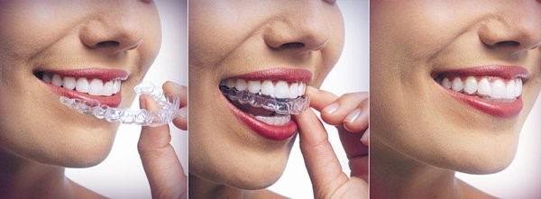 Niềng răng invisalign dễ dàng tháo lắp khi sử dụng