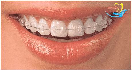 Niềng răng có ảnh hưởng đến thần kinh không