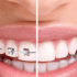 So sánh niềng răng mắc cài và niềng răng invisalign