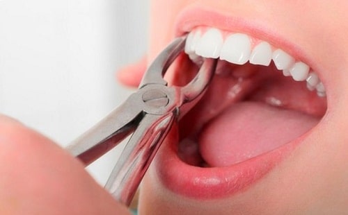 Tại sao phải nhổ răng trước khi niềng răng