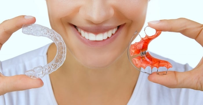 Đeo hàm duy trì sau niềng răng mất bao lâu?