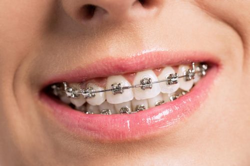 Niềng răng có giới hạn độ tuổi không?
