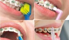 Hướng dẫn chải răng đúng cách khi niềng răng mắc cài