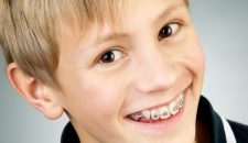 5 dấu hiệu nhận biết răng hô ở trẻ em
