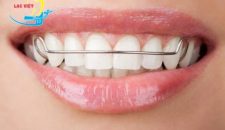 Các loại hàm duy trì sau khi niềng răng