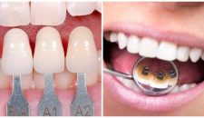 Răng mọc lệch nên niềng răng hay bọc sứ?