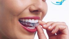 Niềng răng invisalign có tốt và hiệu quả không?