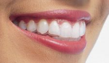 Các loại hình niềng răng trong suốt