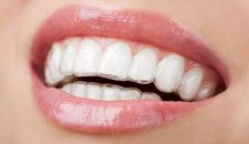 Niềng răng không mắc cài mất bao lâu?