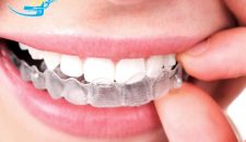 Niềng răng invisalign hiệu quả thế nào?