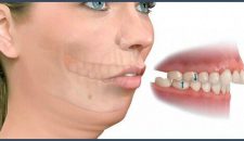 Các phương pháp chỉnh răng hô hiệu quả nhất