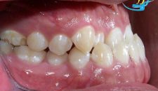 Răng móm có di truyền hay không?