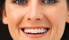 Tuổi tác có ảnh hưởng đến kết quả niềng răng không?